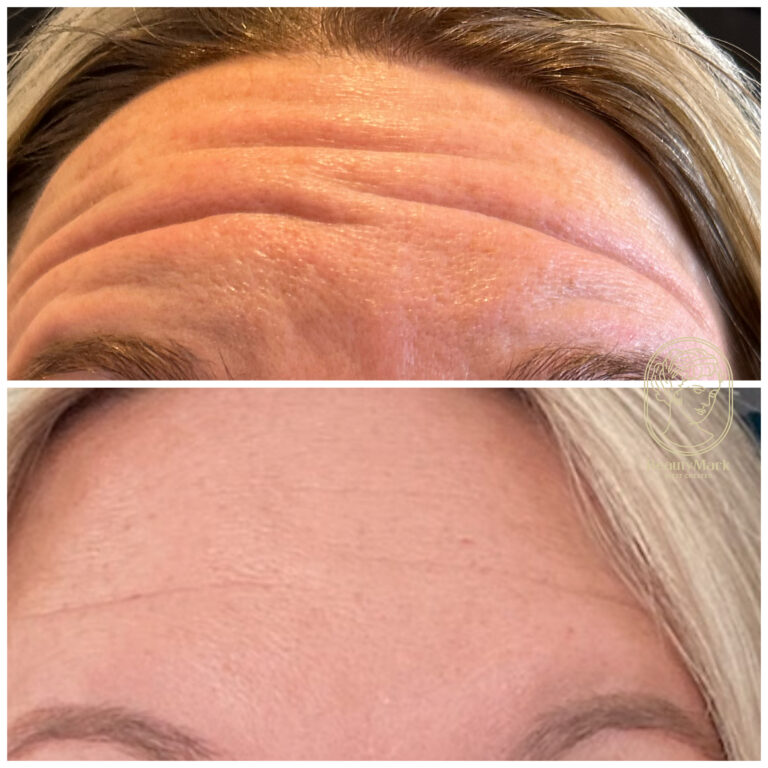 Anti-Wrinkle Injections Before and After