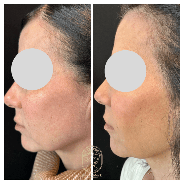 8 (1Dermal Fillers Before and After
