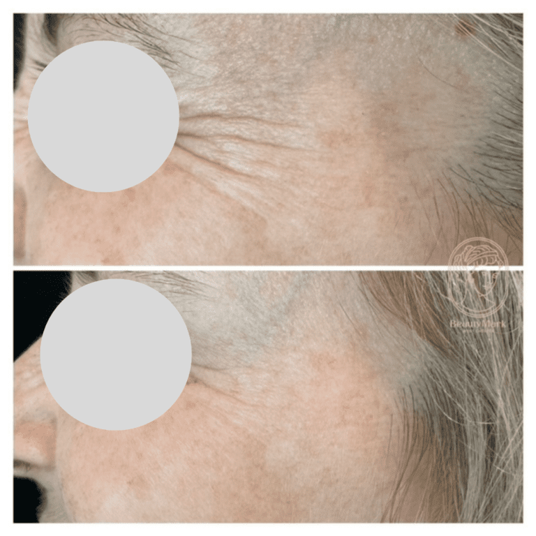 Anti-Wrinkle Injections Before and After