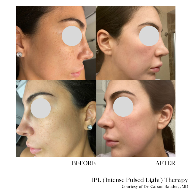 Intense Pulsed Light (IPL) Therapy