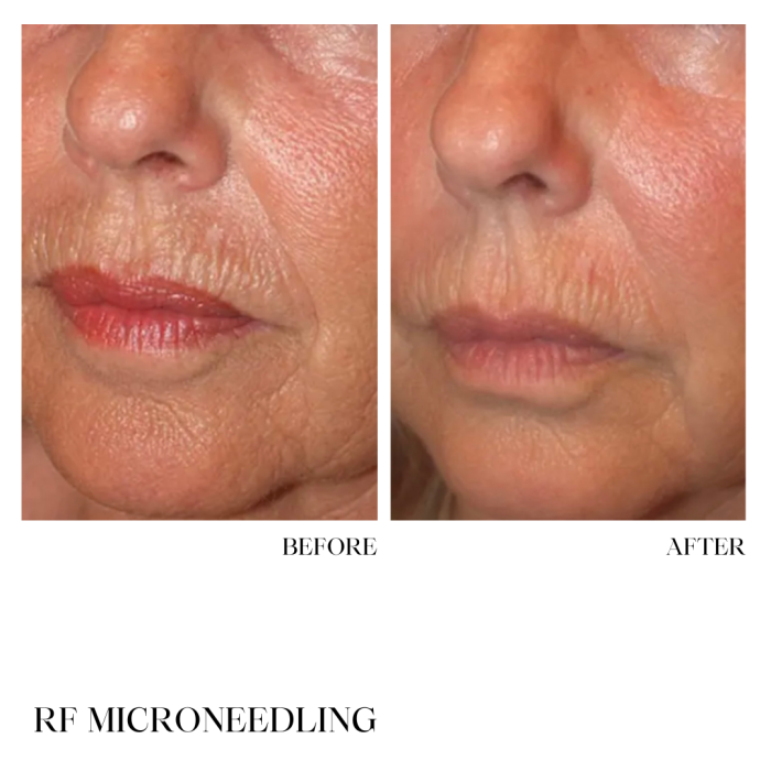 BEFORE & AFTER MICRONEEDLING & RADIO FREQUENCY MICRONEEDLING
