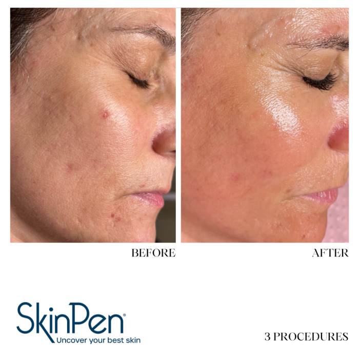 BEFORE & AFTER MICRONEEDLING & RADIO FREQUENCY MICRONEEDLING